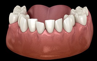 Illustration of crowded teeth