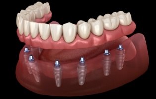 Animated full denture being placed onto eight dental implants