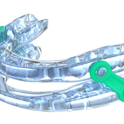 Close-up of an oral appliance for sleep apnea in Fair Oaks, CA