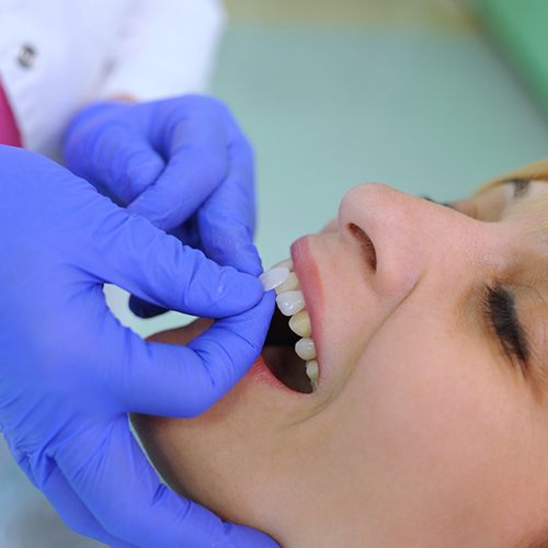 Woman having veneer placed on her tooth by cosmetic dentist